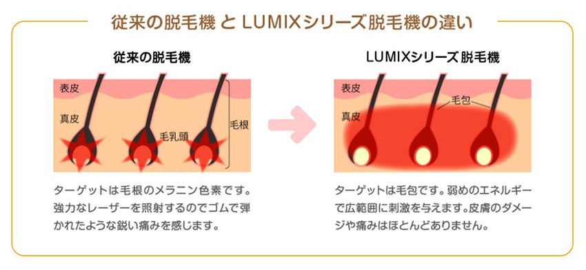 従来の脱毛機とLUMIXシリーズ脱毛機の違い