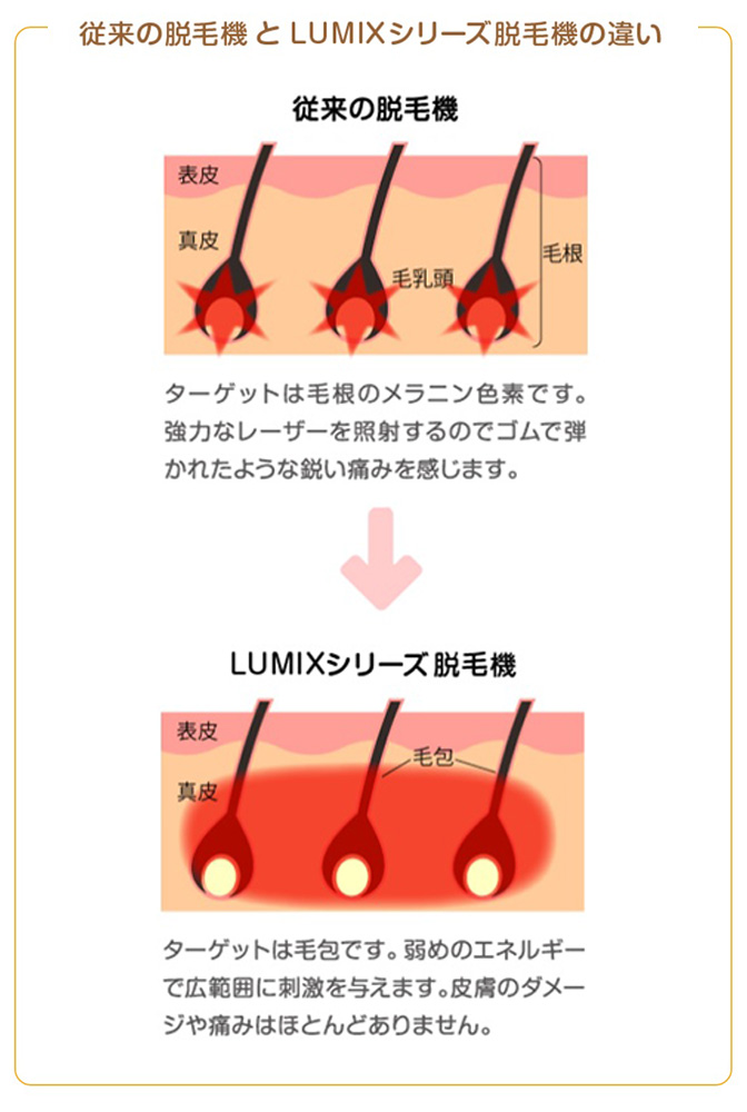 従来の脱毛機とLUMIXシリーズ脱毛機の違い